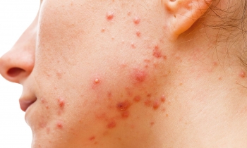 acne-moyen